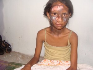 A Christian girl who was bruised and burnt during the Orissa violence in August 2008. This girl was injured with burns bruises during anti Christian violence by Hindu nationalists. It occured when a bomb was thrown into her house by extremists. Image, caption courtesy All India Christian Council