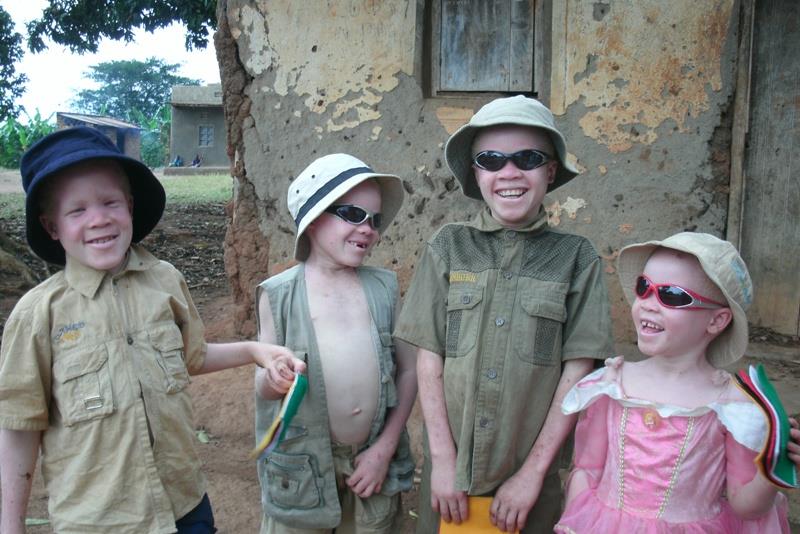 Albinism: a ‘curse’ turned blessing